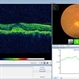 Choroidal Osteoma Plus CNV Choroidal Osteoma Plus CNV